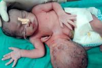 Bayi Dua Kepala Selamat Melalui  Operasi