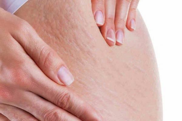 Kebanyakan orang beranggapan stretch mark muncul karena kebiasaan menggaruk kulit saat menstruasi atau melahirkan.