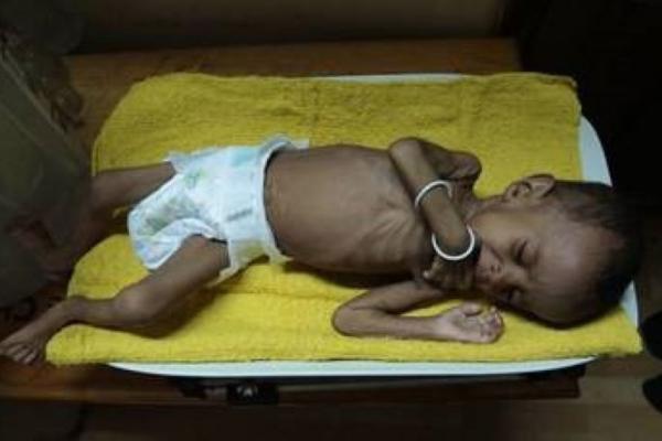 Lebih dari satu juta anak-anak menderita kekurangan gizi di tengah wabah kolera yang mematikan di Yaman