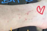 Digigit Ular, Bagaimana Kondisi Lindsay Lohan?