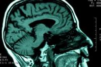 Cedera Otak Picu Terserang Penyakit Demensia