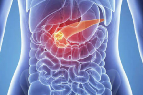 Kanker pankreas adalah salah satu penyakit pembunuh terbesar di berbagai negara seperti di Amerika dan Singapura.