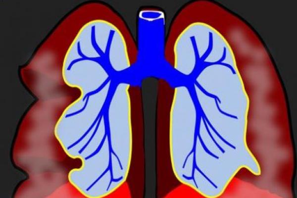 Sebuah studi yang dilakukan peneliti Inggris menemukan kerusakan paru-paru yang cukup kritis pada pasien-pasien yang meninggal akibat Covid-19.