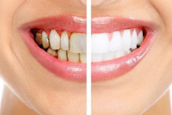 Dokter gigi spesialis konservasi Dewi Isroyati dari Universitas Indonesia mengatakan harus ada jeda dari waktu makan dan menyikat gigi, setidaknya 30 menit, agar kandungan asam yang berasal dari glukosa sudah menurun.