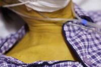 30 Tahun Merokok, Pria Ini Terkena Penyakit Kuning