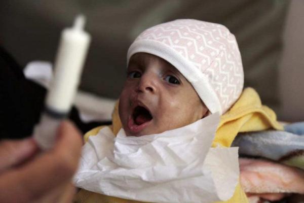 PBB memproyeksikan peningkatan 22 persen pada malnutrisi akut yang parah di antara anak-anak balita di Yaman, dibandingkan dengan tahun 2020