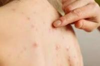 Terkena Herpes Masa Pandemi Covid-19, Cepat Sembuh Jika Lakukan Ini