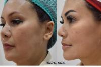 Empat Langkah Hilangkan Dagu Berlipat Tanpa Operasi