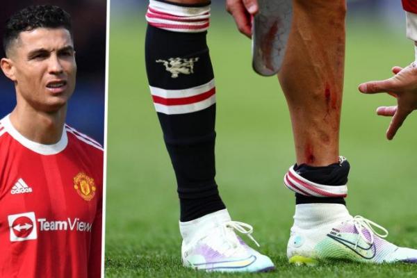 Cristiano Ronaldo menunjukkan luka memar dan tulang kering yang berlumuran darah, usai laga Manchester United (MU) vs Everton pada Sabtu (9/4) malam.