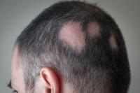 AS Setujui Pil Pertama untuk Pengobatan Alopecia