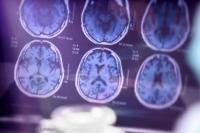 AS Setujui Obat Baru Obati Penyakit Alzheimer