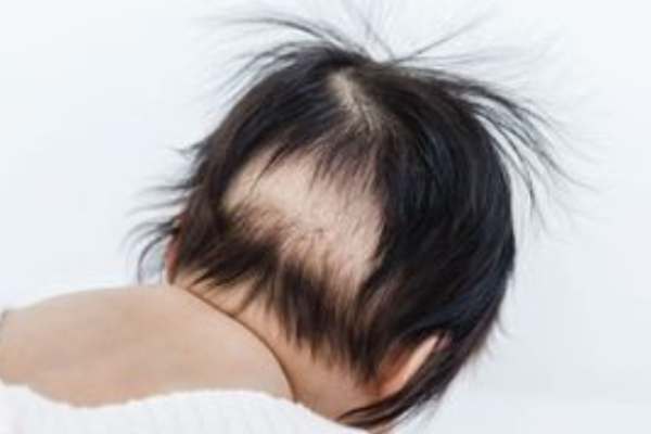 Moms, jangan terlalu khawatir saat melihat pertumbuhan ramjbut bayi tidak merata atau botak