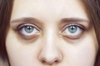 Mata Panda Buat Tidak Percaya Diri, Lakukan Ini untuk Hilangkan