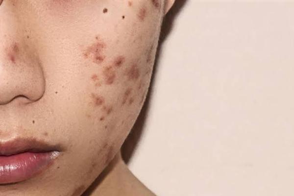 Manfaat madu selain khasiat bagi kesehatan tubuh, juga dapat menghilangkan bekas jerawat secara efektif