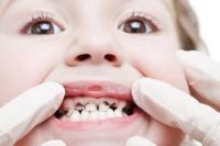 Begini Caranya Meredakan Nyeri Gigi Berlubang Tanpa Obat