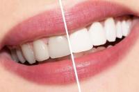 Tips Ampuh Gigi Menjadi Putih Sehat dan Alami