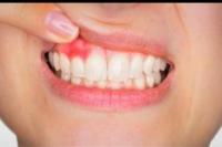 Bahan Alami Ampuh Atasi Gusi Bengkak