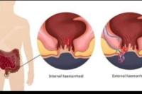 Inilah Cara Obati Wasir Pakai Bahan Alami