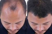 Ilmuwan Temukan Serum Penumbuh Rambut Berbasis Tanaman Tropis