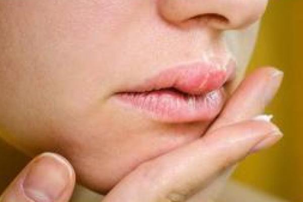 Cara mengatasi bibir bengkak yang paling mudah dan aman adalah dengan kompres air dingin.