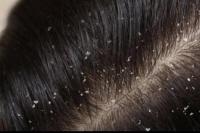 Penyebab Ketombe di Kepala, Akibat Sampo atau Polusi?