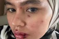 Wajah Kartika Putri Penuh Lebam, Bahkan Sampai ke Rongga Mulut
