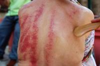 Fakta atau Mitos Kerokan Dapat Redakan Masuk Angin