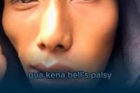 Viral, Pria Alami Bell`s Palsy setelah Tidur Terpapar Kipas Angin, Apa Kata Dokter?