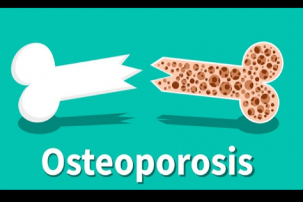 Ini Makna di Balik Peringatan Hari Osteoporosis Sedunia
