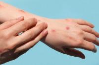 Ilustrasi cacar air (Foto: Doknet)