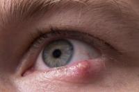 Jangan Panik! Ini Cara Menghilangkan Bintitan di Mata