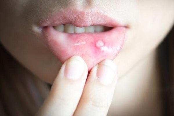 Kenapa Sariawan Bisa Muncul? Ini Sebab Utamanya