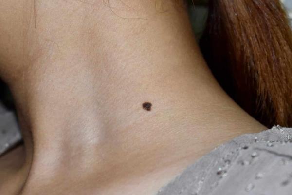 Tak Semua Tahi Lalat Berarti Tanda Lahir, Ini Perbedaannya