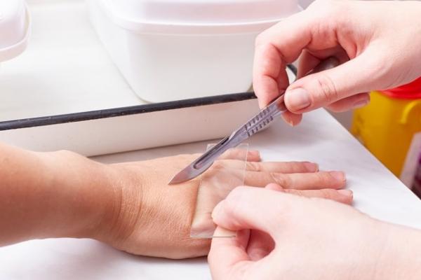 5 Tanda Awal Penyakit Kusta yang Sering Diabaikan