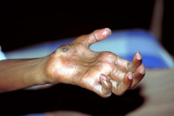 7 Mitos dan Fakta Penyakit Kusta yang Harus Diluruskan