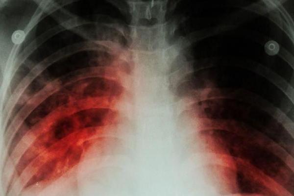 Ini Cara Membedakan Infeksi Paru-Paru dari Bakteri atau Virus