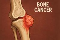 7 Gejala Kanker Tulang yang Sering Diabaikan