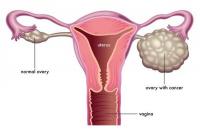 Perempuan Single Berisiko Terkena Kanker Ovarium, Benarkah?
